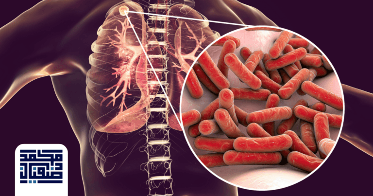 السل المعوي