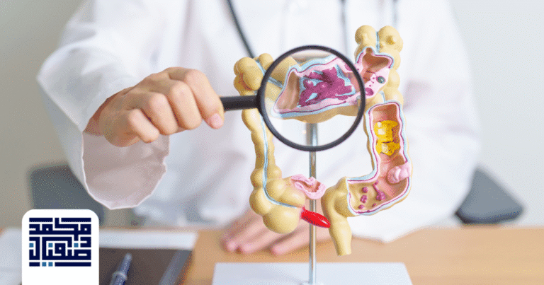 صورة توضيحية لجهاز القولون والجهاز الهضمي مع إبراز التهابات القولون التقرحي، ضمن مقال عن أسرع طريقة لعلاج التهاب القولون التقرحي مع نصائح طبية من د. محمد صفيان.