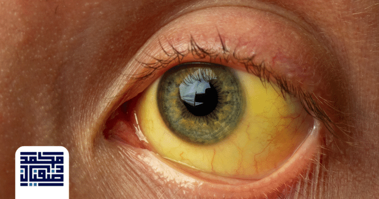 أعراض مرض ويلسون عند الكبار