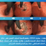 عملية ارتجاع المريء بالمنظار | الدليل الشامل