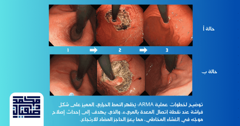 عملية ارتجاع المريء بالمنظار | الدليل الشامل