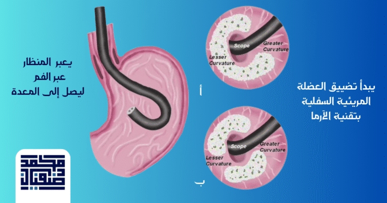عملية أرما لعلاج ارتجاع المريء (ARMA)